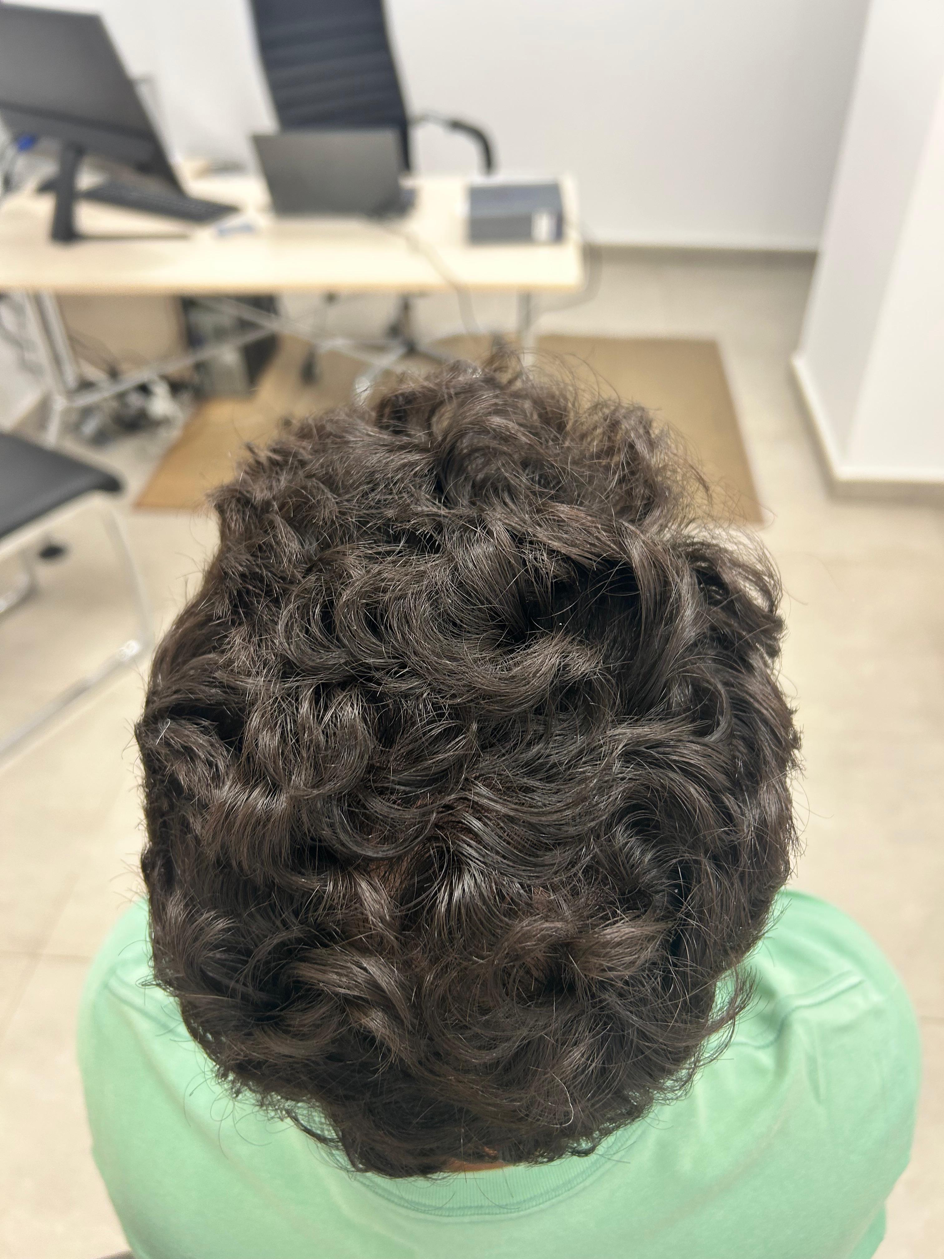 Después del tratamiento · Caso 2